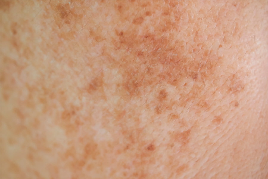 Efecto de la hiperpigmentación en la piel
